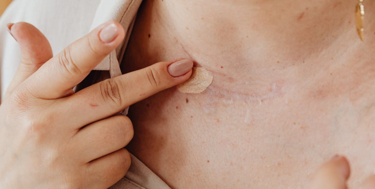 Odszkodowanie za blizny powypadkowe – co powinieneś wiedzieć?