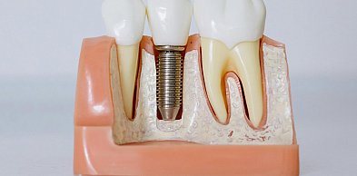 Ile trwa proces implantacji zębowej?