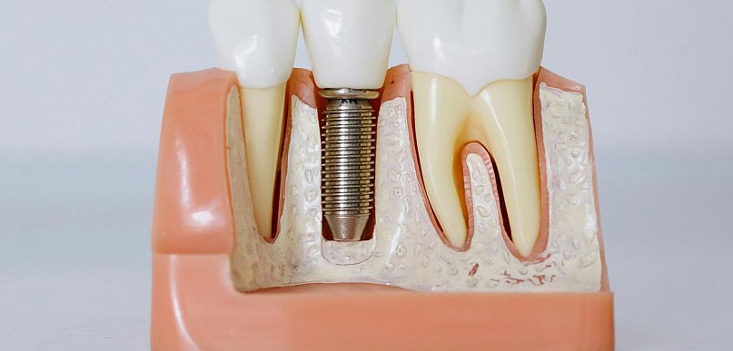 Ile trwa proces implantacji zębowej?