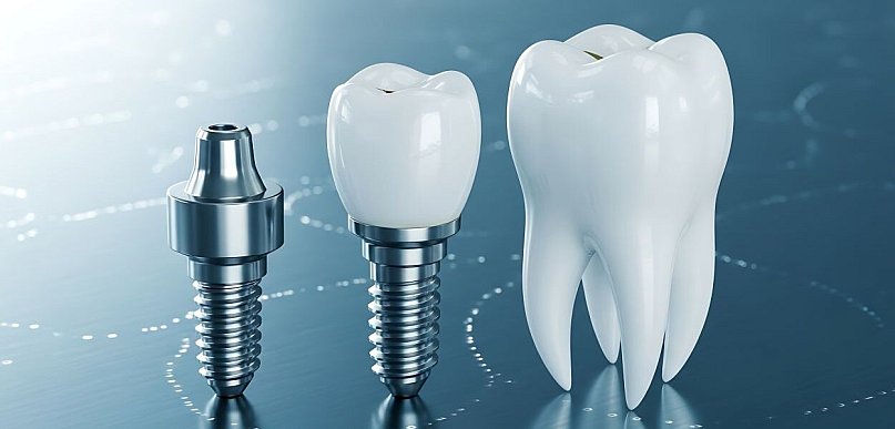 Cennik implantów zębowych 2026 — ile zapłacisz za pełne leczenie?