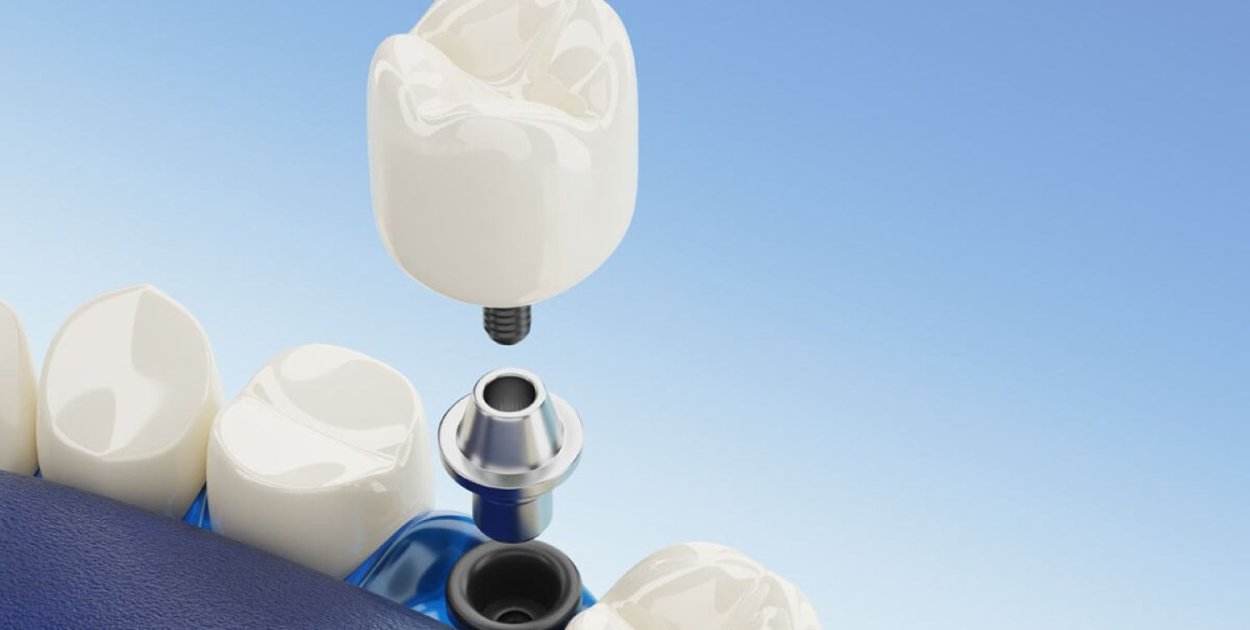 Czy implant zęba może sprawiać ból?